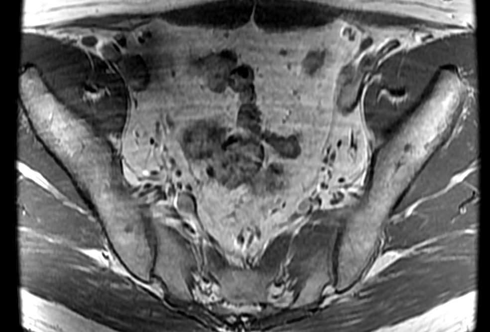 Figure 2 for case Bilateral accessory piriformis muscles